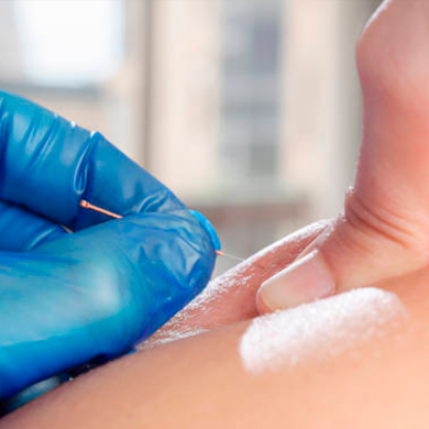 Fisioterapia Invasiva, Punción Seca